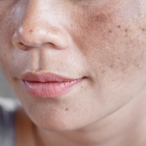 Hyperpigmentation